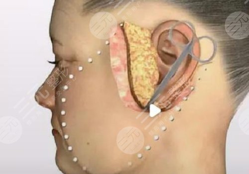 小切口拉皮手術(shù)費多少錢