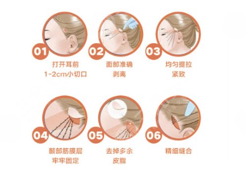 小切口拉皮手術(shù)費多少錢