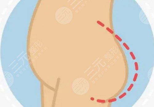 脂肪豐臀多久能恢復(fù)好？