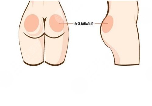 脂肪豐臀多久能恢復(fù)好？