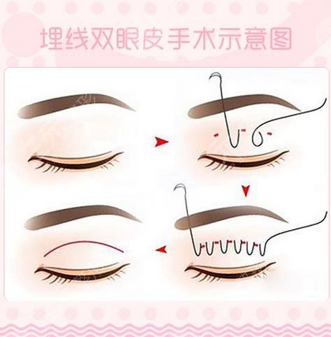 魏國茜雙眼皮案例