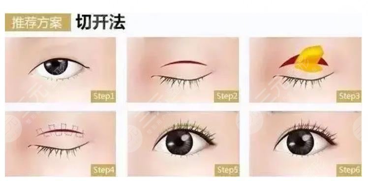 魏國茜雙眼皮案例