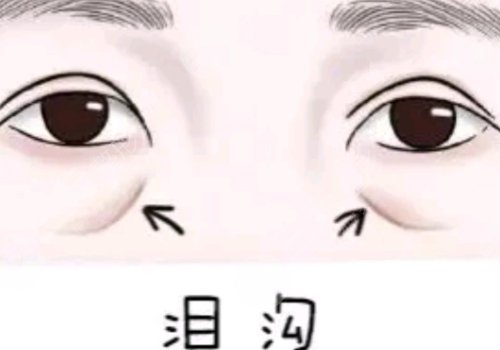 淚溝凹陷怎么解決好？