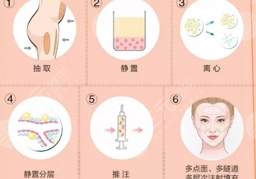 深圳美萊郭杰的抽脂真實水平怎么樣