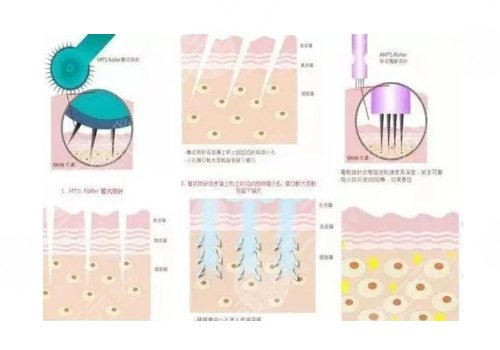 鐳射凈膚儀祛斑會反彈嗎