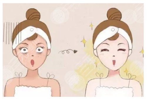 鐳射凈膚儀祛斑會反彈嗎