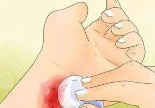 鐳射凈膚儀祛斑有副作用嗎？