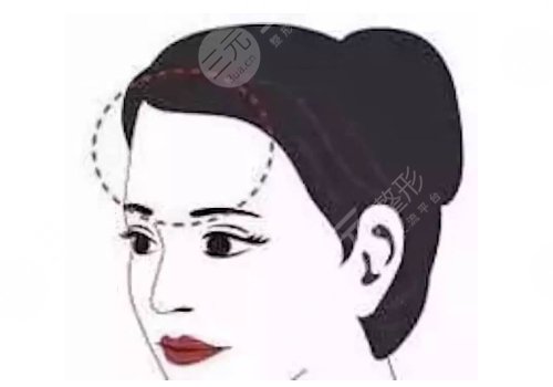 額頭填充有風(fēng)險嗎