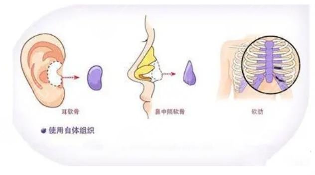 桂行軍鼻子隆鼻案例
