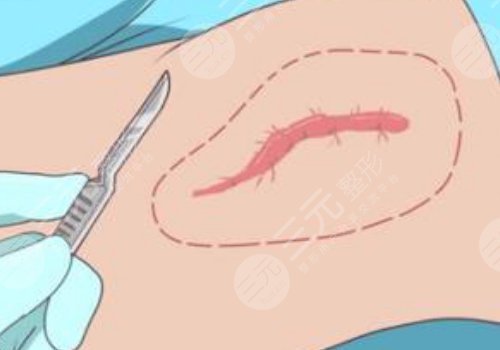 于艷菊教授疤痕專家