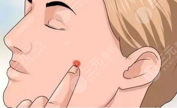 上海七院整形科激光祛痘案例分享