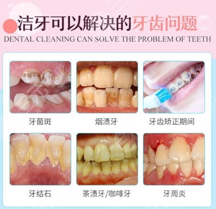 超聲波潔牙