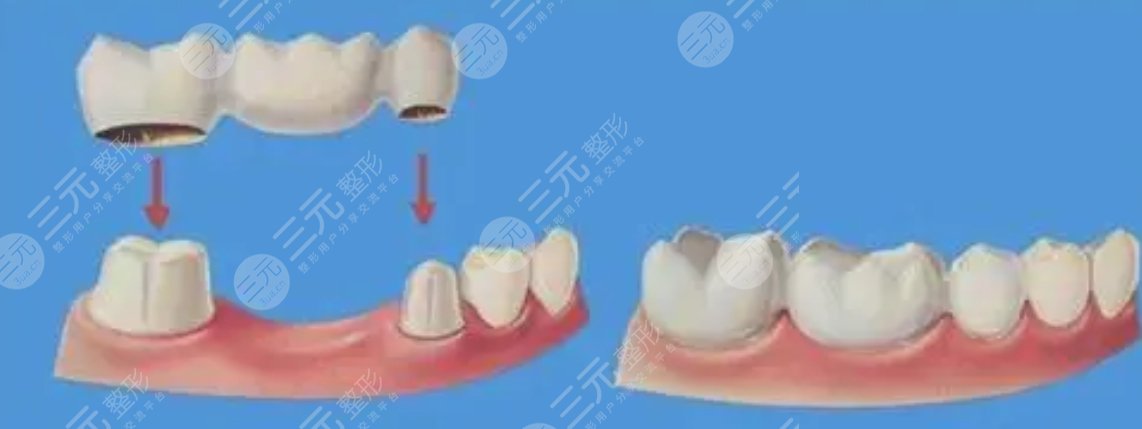 固定義齒修復(fù)