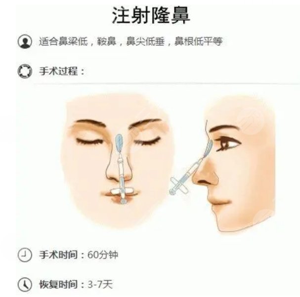 玻尿酸隆鼻