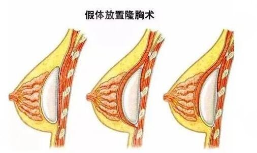 韓國蓓拉假體的價(jià)格貴嗎？