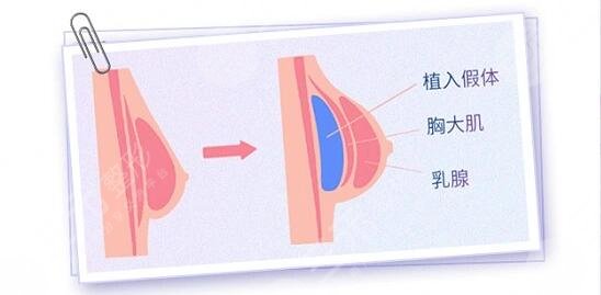 韓國蓓拉假體的注意事項(xiàng)有哪些？