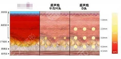 7d聚拉提和超聲炮的區(qū)別在哪里