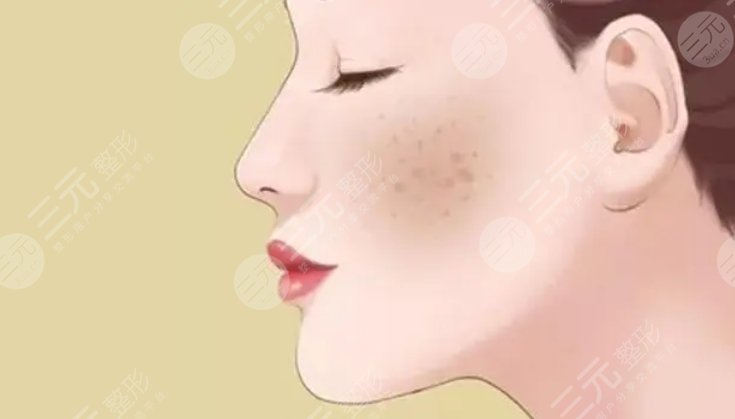 蝴蝶斑