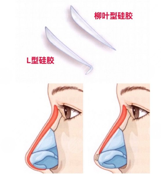上海同濟(jì)醫(yī)院整形外科隆鼻案例分享
