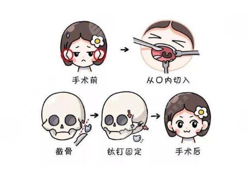 下頜手術大概需要多少錢