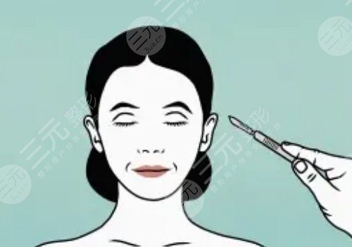 拉皮手術能維持幾年