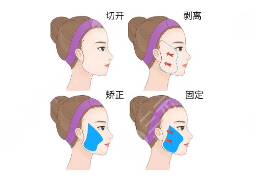 拉皮手術能維持幾年