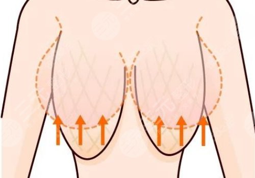 上海九院做胸下垂緩解好嗎，多少錢