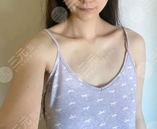 水滴型假體隆胸前后對比效果圖片和手術(shù)過程分享，小白隆胸避坑！