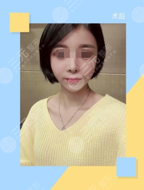 做自體脂肪豐額頭手術(shù)一個(gè)月以后