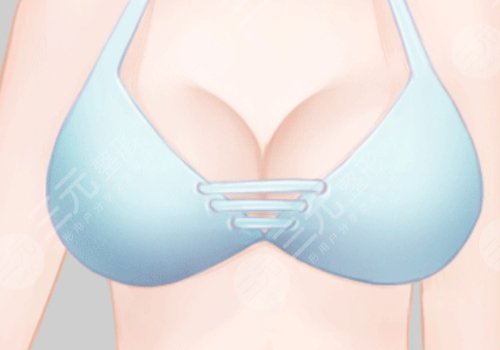 穆大力醫(yī)生做胸的真實(shí)術(shù)后感