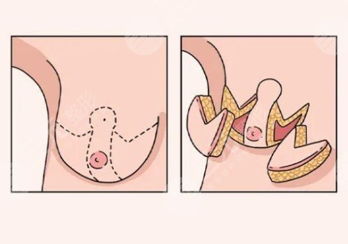 胸大可以做手術(shù)變小嗎