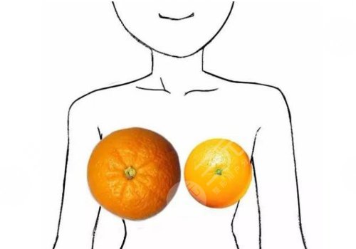 胸大可以做手術(shù)變小嗎