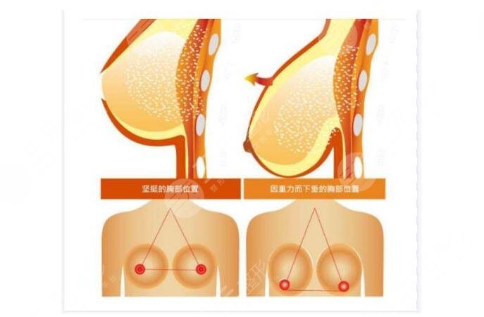 徐國建做胸部懸吊怎么樣
