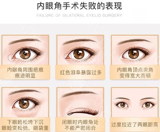 合肥李小靜眼角回包修復(fù)案例分享！安醫(yī)熱門(mén)整形醫(yī)生，等你品評(píng)~