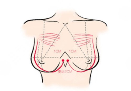長(zhǎng)沙湘雅二醫(yī)院隆胸貴嗎