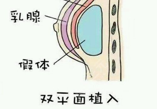 長(zhǎng)沙湘雅二醫(yī)院隆胸貴嗎