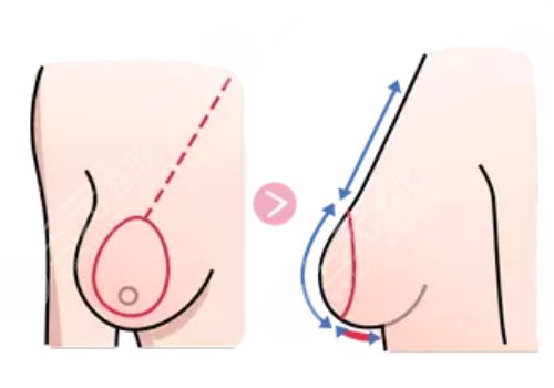 珠江醫(yī)院縮胸多少錢