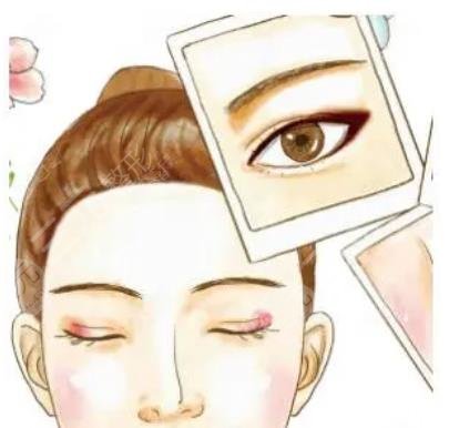 顧勤浩醫(yī)生雙眼皮手術(shù)案例