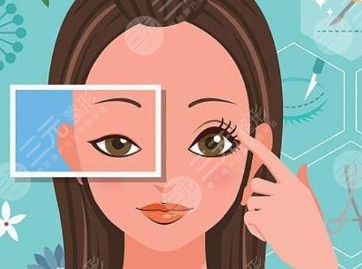 劉娟醫(yī)生雙眼皮手術案例