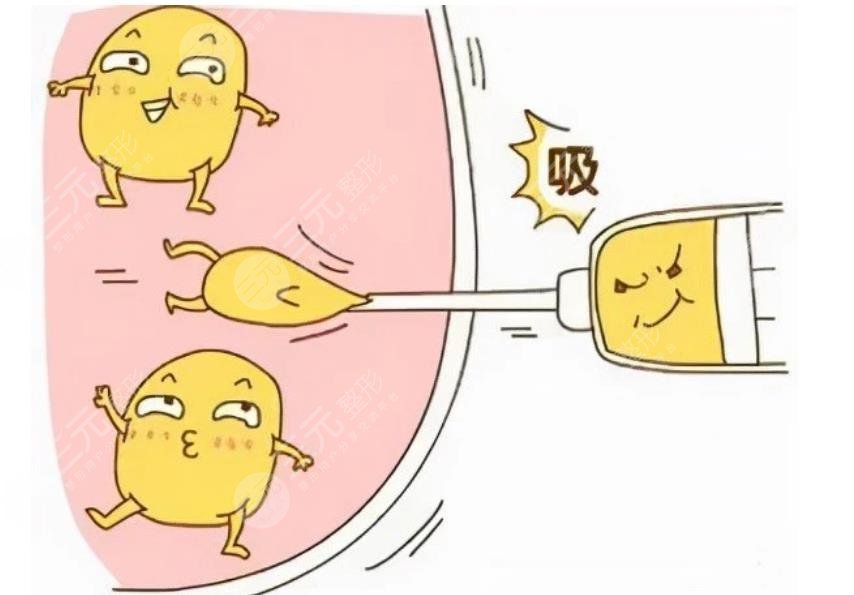 何永強(qiáng)醫(yī)生吸脂塑形手術(shù)案例