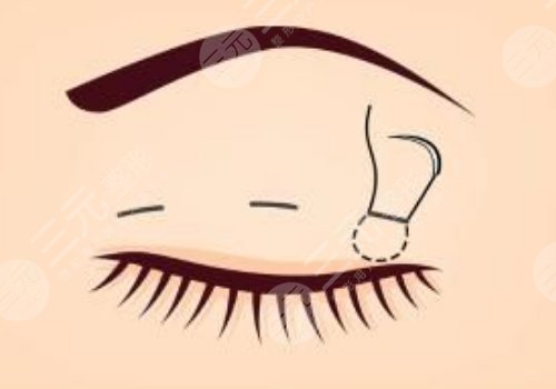 馬菁晶雙眼皮怎么樣