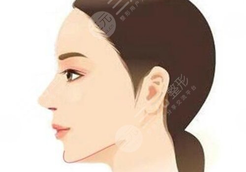 下顎線整形多少錢