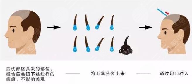 植發(fā)