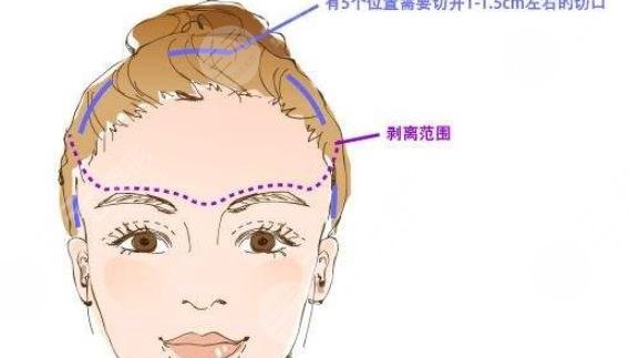 內(nèi)窺鏡除皺