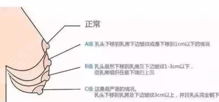 乳房矯正