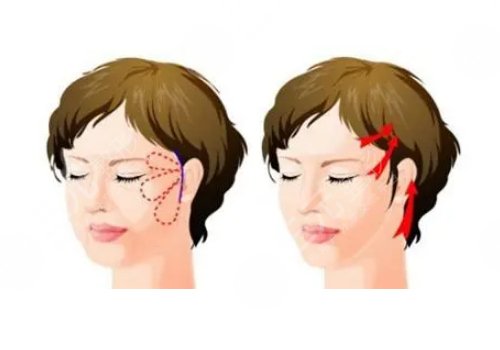 做拉皮手術能保持多少年