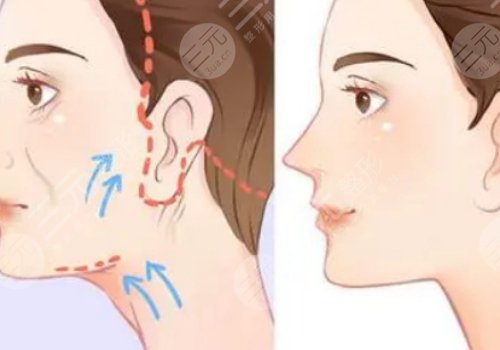 做拉皮手術能保持多少年