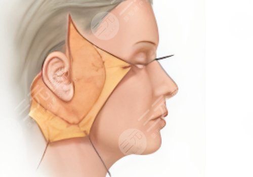 做拉皮手術能保持多少年