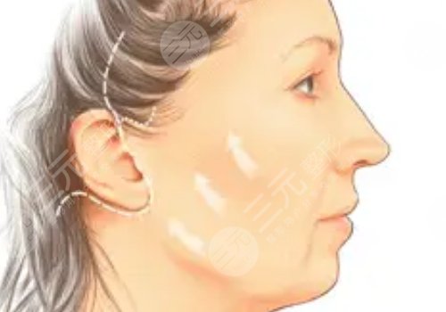 做拉皮手術能保持多少年