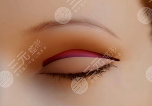 曹麗紅雙眼皮做的可以嗎